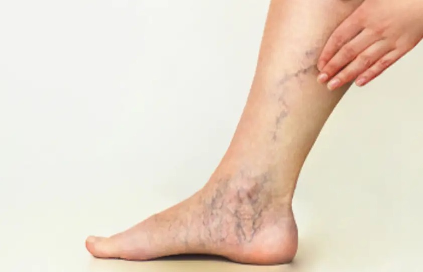 simptomele de pânza de sânge în varicoza cel mai puternic picior varicos